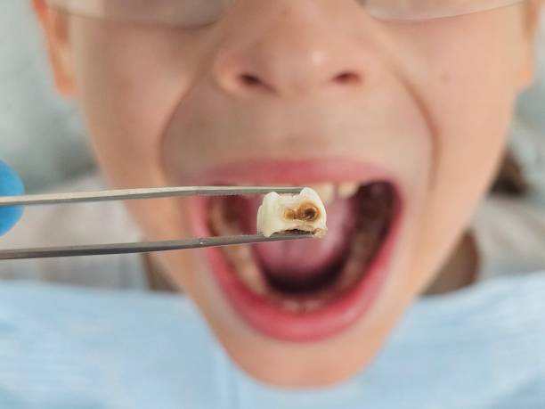 Best Emergency Treatment for Dental Infections or Abscesses in Ogallala, NE