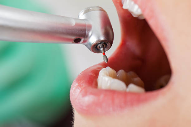 Best Emergency Tooth Extraction in Ogallala, NE